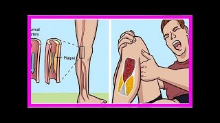 6 anticoagulants naturels pour prévenir la formation de caillots dans le sang [upl. by Ahsilra]