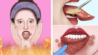 ASMR Canker sores cause of mouth ulcer treatment  Tonsil stone removal animation [upl. by Naired]