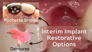 Rochette Bridges and Provisional Prostheses for Implants – PDP145 [upl. by Ennayelhsa214]