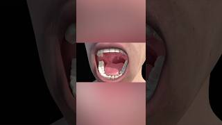 Tonsillitis medicalanimation health [upl. by Sherrod]