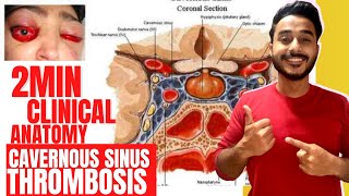 thrombosis of cavernous sinus anatomy  dangerous area of face clinical anatomy of cavernous sinus [upl. by Aysan]