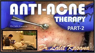 BLACKHEAD EXTRACTION PART 2 BY DR LALIT KASANA [upl. by Othe561]