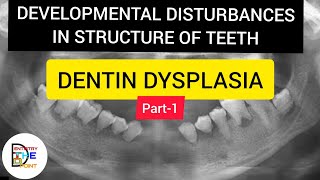 DENTIN DYSPLASIA ROOTLESS TOOTH PART1 Developmental Disturbances of structure of teeth [upl. by Eiduj]