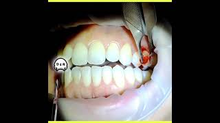 Peripheral Ossifying Fibroma Excision on Buccal Gingiva [upl. by Drud]