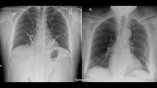 Hemothorax pneumothorax pleural effusion [upl. by Funch843]