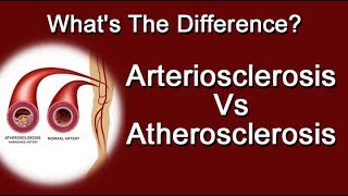 Arteriosclerosis Vs Atherosclerosis  Whats The Difference [upl. by Xirdnek]