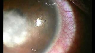 Hypopion Corneal Ulcermpg [upl. by Anairda]