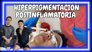 HIPERPIGMENTACIÓN POSTINFLAMATORIA  javierderma [upl. by Nonnairb]