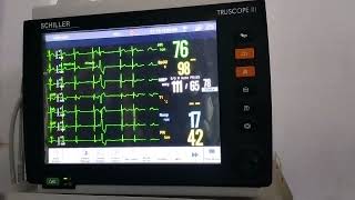 case of Ventricular Bigeminy changing to Trigeminy and Quadrigeminy [upl. by Ardnad403]