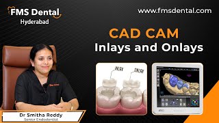 CADCAM Inlays and Onlays by Dr Smitha Reddy  FMS Dental [upl. by Barny]