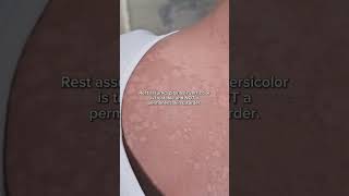 Pityriasis Versicolor What You Need to Know [upl. by Cyril]