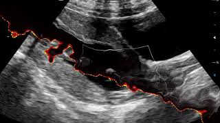 Vasa Previa on ultrasound Scan [upl. by Htedirem722]