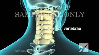 Lumbar Laminectomy [upl. by Okomom]