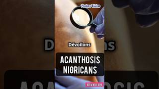 Acanthosis nigricans Acanthosis nigricans acanthosisnigricans hyperpigmentation pigmentation yt [upl. by Figone]