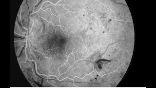 TFOS DEWS II Diagnostic Videos  Ocular surface damage [upl. by Dadelos398]