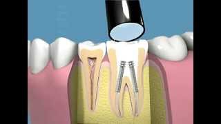 Tutti i passaggi della terapia canalare e della capsula dentale [upl. by Teague]