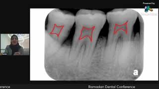 importance of xRay in endodontics part 1 [upl. by Jordon]