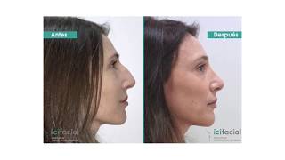 Patricia  Paciente de Rinoplastia Ultrasónica en Icifacial [upl. by Corkhill207]