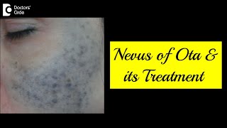 NEVUS OF OTAWhat is it and How is it Treated Skin PigmentationDrRajdeep Mysore Doctors Circle [upl. by Lance]