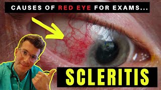 Causes of Red Eye  Part 3 SCLERITIS [upl. by Leavelle512]