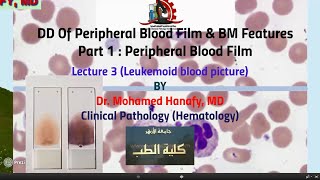 Part1  Peripheral Blood Film Lecture 3 Leukemoid blood picture [upl. by Alaj]