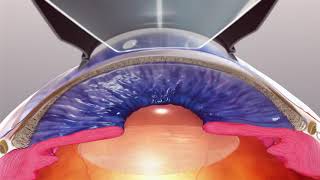 Ellex Selective Laser Trabeculoplasty SLT Animation  Patients [upl. by Cave]