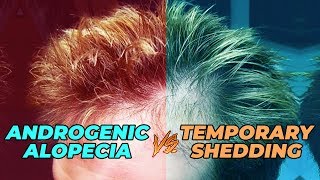 How To Test If Your Hair Loss Is Androgenic Alopecia Or Temporary Shedding [upl. by Eendyc]