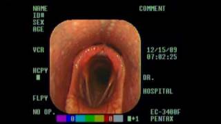 Normal Larynx mpg [upl. by Sebbie]