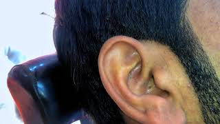 Blackheads in the Ear pimples medication poppingblackheads [upl. by Sello]