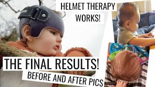 Flat Head Syndrome Helmet TherapyFinal ResultsPlagiocephalyBrachycephaly [upl. by Ciprian]