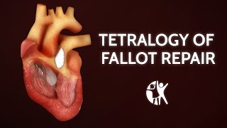 Tetralogy of Fallot Repair  Cincinnati Childrens [upl. by Helbonia]