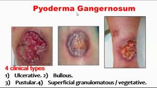 Pyoderma gangernosum [upl. by Fadil]