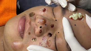 blackheads new 2023  popping pimple today  blackheads and whiteheads removal [upl. by Indnahc]