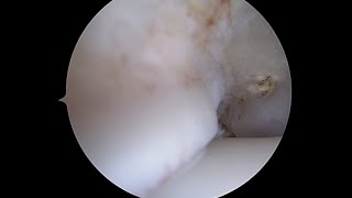 Anteromedial Soft Tissue in the Ankle after Removal of Impingement [upl. by Beaner]