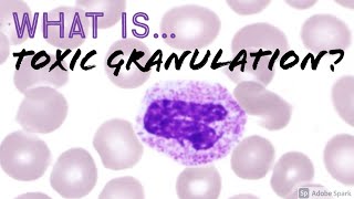 What is quotToxic Granulationquot of Neutrophils Why does it happen Hemepath Hematology Basics [upl. by Ruder92]