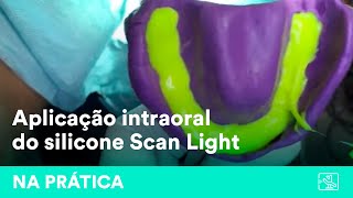 Moldagem com aplicação intraoral do silicone de adição Scan Light  por dr Cássio Pontes [upl. by Odnomor]