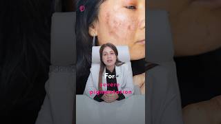 How to treat pigmentation on facepigmentationremoval pigmentation [upl. by Yelsew]