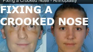 Fixed a Crooked Nose – Rhinoplasty in San Francisco – Dr David Kim [upl. by Tirma]