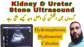 Kidney stone  ureter stone  Hydronephrosis  Hydroureter  Dr Qazi Fahim Shezad [upl. by Leta701]