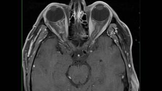 Optic Neuritis [upl. by Jareen]