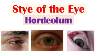 Eye Stye Hordeolum  Causes Symptoms Diagnosis amp At Home Treatments [upl. by Lura]