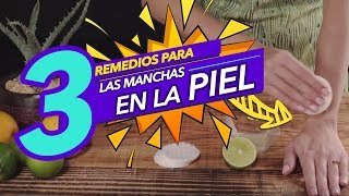 Los mejores remedios para eliminar las manchas en la piel [upl. by Atwekk]