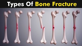 Breaking Down Femur Fractures  What You Need to Know [upl. by Brothers]