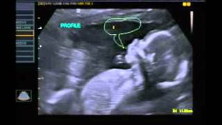 Ultrasound at 18 weeks 6 days [upl. by Vassili207]