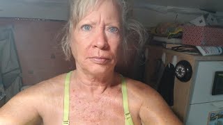 Fluorouracil 5 Half way mark video diary skin cancer [upl. by Ethelbert892]