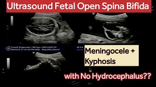 Ultrasound Fetal Spina Bifida with Meningocele and Kyphosis  what are Risk Factors [upl. by Ecirtac522]