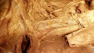 Aorta  Vena Cava  Azygos Vein  Cisterna Chyli Dissection and Clinical Narration – Sanjoy Sanyal [upl. by Suaeddaht]