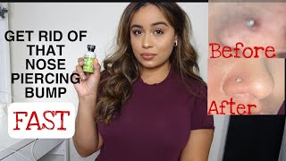 HOW TO GET RID OF A NOSE PIERCING BUMP IN 2 DAYS Fast [upl. by Newbill]