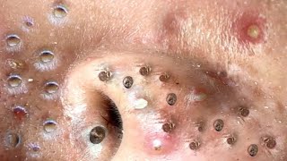 blackheads new 2023  popping pimple today  blackheads and whiteheads removal [upl. by Stephen]