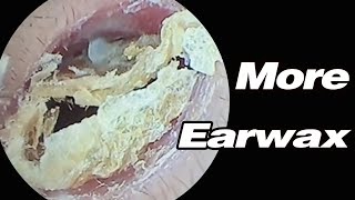 Ear Picking Earwax Is Super Heavy And Its Blocking My HearingASMRearwax耳掃除 [upl. by Michell]